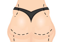 5 Common Myths Regarding Liposuction Surgery