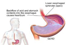 Acid Reflux and Heartburn Natural Remedies