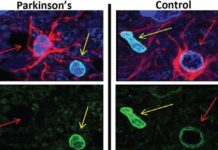 Flushing out ‘zombie cells’ could help stave off Parkinson’s, study suggests