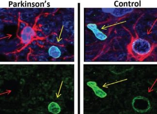 Flushing out ‘zombie cells’ could help stave off Parkinson’s, study suggests