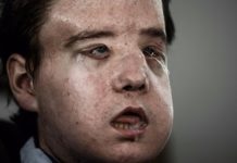 Jérôme Hamon: Frenchman gets ‘third face’ in new transplant