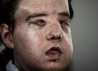 Jérôme Hamon: Frenchman gets ‘third face’ in new transplant