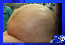 132-pound ovarian tumor removed from Connecticut woman By Mark Lieber, CNN