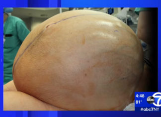 132-pound ovarian tumor removed from Connecticut woman By Mark Lieber, CNN